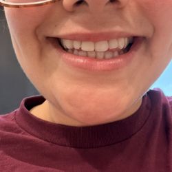 Kaio Dental: Chonway Tram - After Dr.Tram repaired my tooth