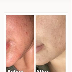 Glam Lash Studios and Skin Bar - Glycolic peel with Dermaplaning