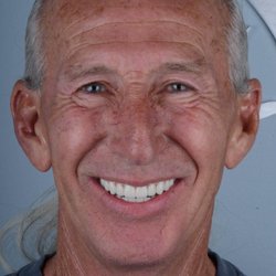 Rockville Dental Arts - After All on 4 Dental Implants