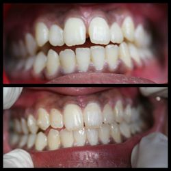 Hollywood Smile Dental - Invisalign