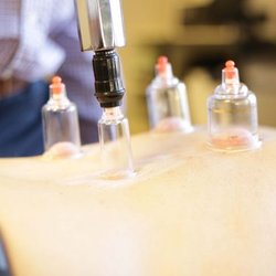 Cupping