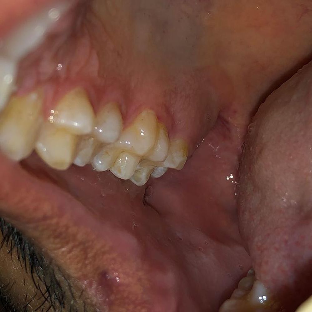 Worst cleaning ever. Upper Jaw Palatal Surface (Inside surface) of the teeth right after cleaning was done. They did not even touch to clean Worst cleaning ever. Upper Jaw Palatal Surface (Inside surface) of the teeth right after cleaning was done. They did not even touch to clean