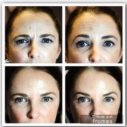 Luxe Beauty Now - Botox before & after