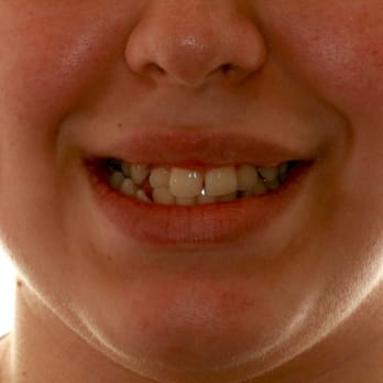Pressutti Orthodontics - Before Braces - Orthodontists Near Me - Fresno, California Pressutti Orthodontics - Before Braces - Orthodontists Near Me - Fresno, California