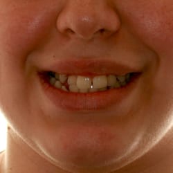 Pressutti Orthodontics - Before Braces