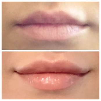 Wayzata Medical Spa - Great results from Kristie again! See how she balanced the uneven shape of my top lip? She is amazing - Medical Spas Near Me - Wayzata, Minnesota