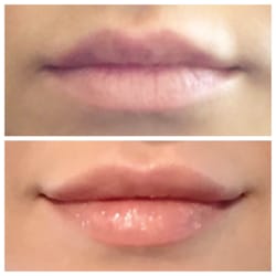 Great results from Kristie again! See how she balanced the uneven shape of my top lip? She is amazing