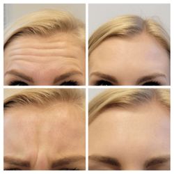 Elan Vital Medical Aesthetics - Anti-wrinkle injections Botox