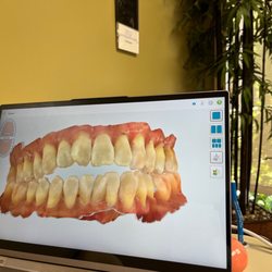 Los Altos Orthodontics - My open bite before Invisalign