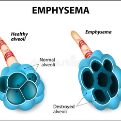 Benjamin Leeman, MD FACP FCCP - THE LUNGS IN EMPHYSEMA