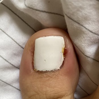 iNails And Spa - Infection - Skin Care Near Me - Chula Vista, California iNails And Spa - Infection - Skin Care Near Me - Chula Vista, California