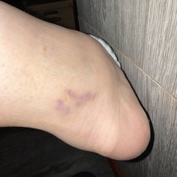 Bruise from massage Bruise from massage