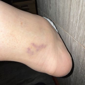 Yu Massage - Bruise from massage - Massage Near Me - Las Vegas, Nevada Yu Massage - Bruise from massage - Massage Near Me - Las Vegas, Nevada