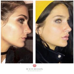 Beauty Religion - Before and after Lip injections with #lipflip on very thin upper lip