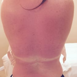 Mountainside Spa - Sunburn, I fried my back!