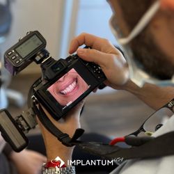 Implantum Dental Clinic - Veneers
