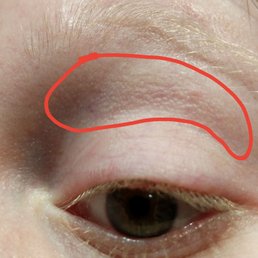 What I circled in red is what my skin looks like healed after two years. It's scaly now and it used to be smooth before it was ripped off.