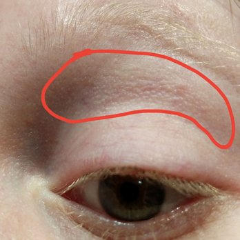 Calla Lily Day Spa - What I circled in red is what my skin looks like healed after two years. It's scaly now and it used to be smooth before it was ripped off. - Day Spas Near Me - Coronado, California