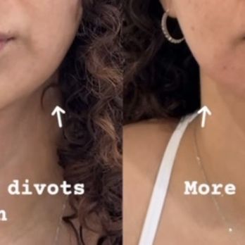 ROUTINE by Anush Movsesian - Before and after the filler - Medical Spas Near Me - Studio City, California ROUTINE by Anush Movsesian - Before and after the filler - Medical Spas Near Me - Studio City, California