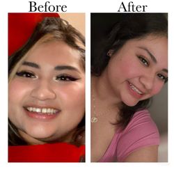 Pacific Dental Smiles - Invisalign treatment