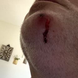 Emergency Room at Arizona General Hospital - Gilbert - This is where he should have cleaned my chin!!