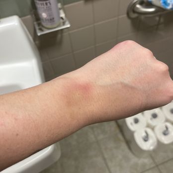Footy Rooty - Bruise - Reflexology Near Me - Killeen, Texas