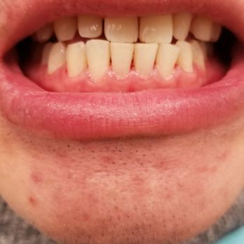 Tristan Lue, DDS - After! Such a wonderful experience. - Cosmetic Dentists Near Me - New York, New York Tristan Lue, DDS - After! Such a wonderful experience. - Cosmetic Dentists Near Me - New York, New York
