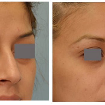 Vladimir Grigoryants, MD - Closed rhinoplasty by Dr. Grigoryants - Cosmetic Surgeons Near Me - Glendale, California