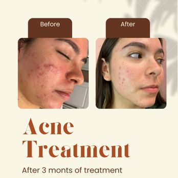 Cleanse Skin Bar - Acne bootcamp - Skin Care Near Me - Mesa, Arizona