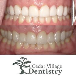 Cedar Village Dentistry - Smile Transformation Before and After- Dr. Thomas Dooley Cedar Village Dentistry