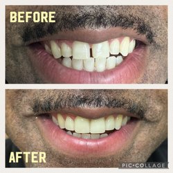 Norco Valley Dental - Before and after Veneers