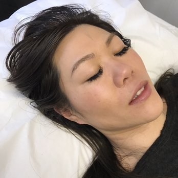 Acupuncture Avenue - a needle in the middle of the forehead - Acupuncture Near Me - San Jose, California