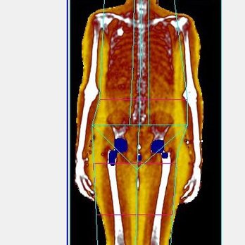 Holland Clinic - DEXA Scanning can Help Identify Exactly Where Body Fat Lies and how Risky it May Be. - Weight Loss Centers Near Me - Albuquerque, New Mexico Holland Clinic - DEXA Scanning can Help Identify Exactly Where Body Fat Lies and how Risky it May Be. - Weight Loss Centers Near Me - Albuquerque, New Mexico