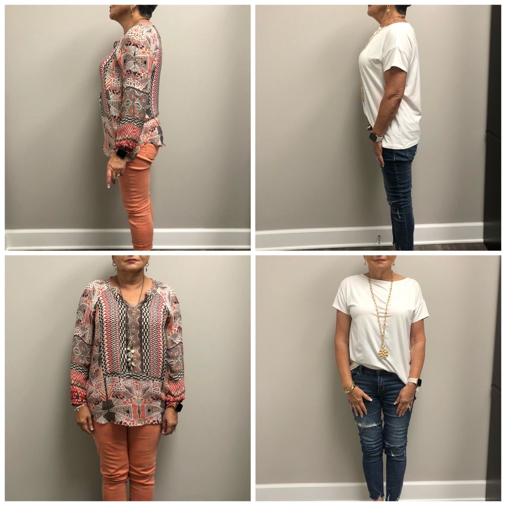 Inspire Weight Loss Image