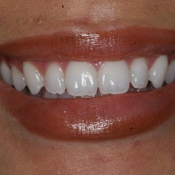 Atlanta Dental Spa - Before - General Dentistry Near Me - Johns Creek, Georgia Atlanta Dental Spa - Before - General Dentistry Near Me - Johns Creek, Georgia
