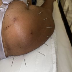 The Healing Sp-ce: Acupuncture & Traditional Asian Medicine - Post surgery treatment for rotator cuff.