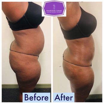 Smooth Body Contours - Body Contouring Near Me - Orlando, Florida