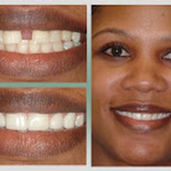 Harmony Dental Care - Kalil Abide - Smile Makeover with Implant Dentistry