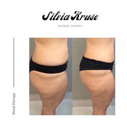 SK Body Studio - Wood Therapy results after 4 sessions