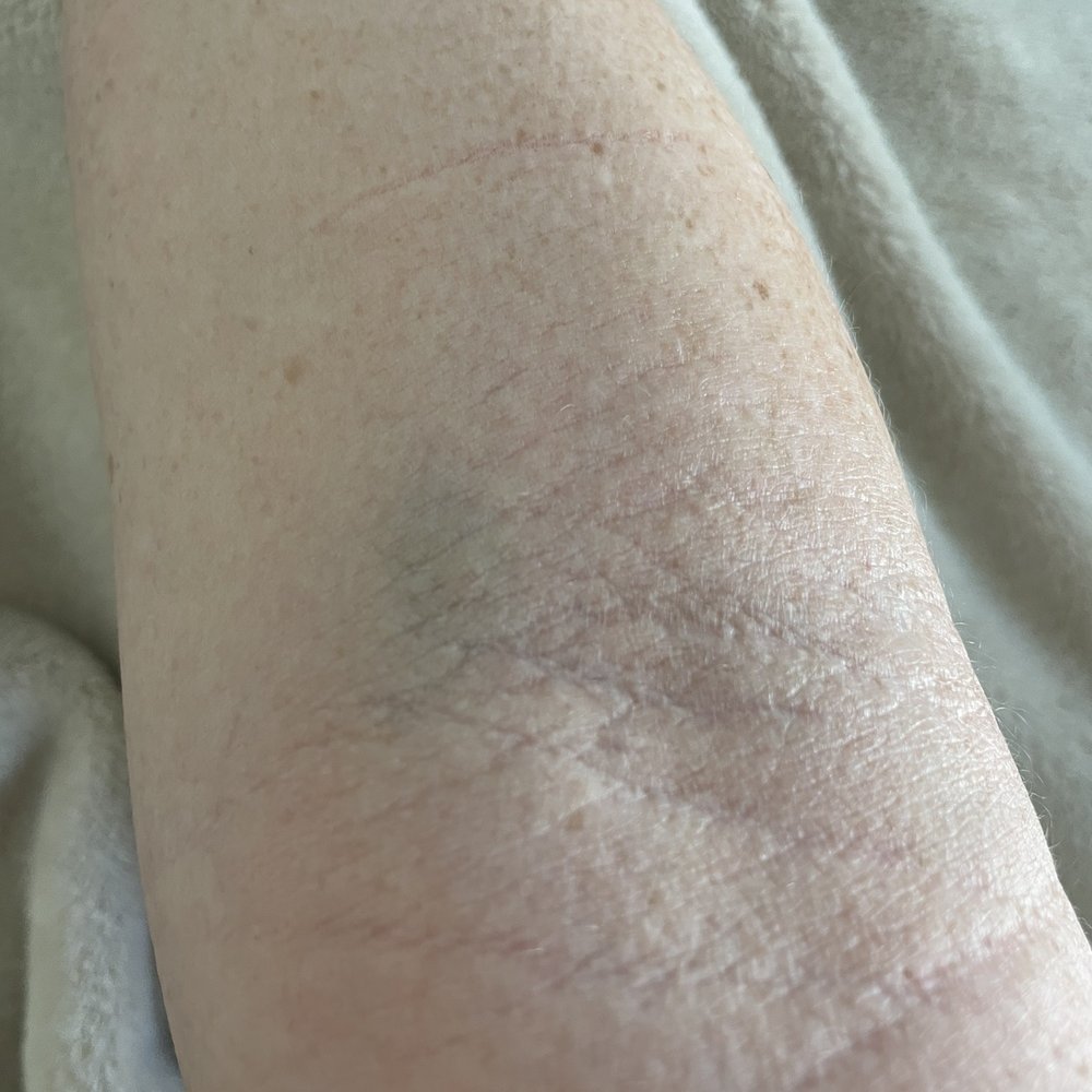 Quest Diagnostics - Bruising in the light and now 2 days post blood work. You can still see injection site. Embarrassing. - Laboratory Testing Near Me - Jacksonville, Florida Quest Diagnostics - Bruising in the light and now 2 days post blood work. You can still see injection site. Embarrassing. - Laboratory Testing Near Me - Jacksonville, Florida
