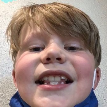 Smiles Orthodontics - Before - Orthodontists Near Me - Puyallup, Washington