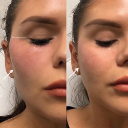 Myst Beauty Bar & Med Spa - One syringe of Juvederm Voluma XC for beautiful, sculpted cheekbones!