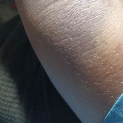 BioLife Plasma Services - That is the bruise going from the puncture site down the side of my arm. I tried to call and speak with someone and no luck.