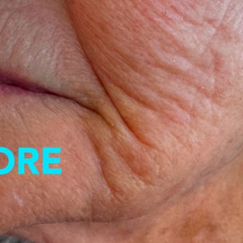 MPZ Dermatology - Frax Resurfacing Laser
Collagen Stimulation
Pore Reduction - Dermatologists Near Me - Corona, California MPZ Dermatology - Frax Resurfacing Laser
Collagen Stimulation
Pore Reduction - Dermatologists Near Me - Corona, California