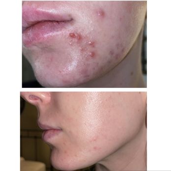Inside Out Aesthetics - Bi-weekly facials - 9 months apart. - Skin Care Near Me - Scottsdale, Arizona Inside Out Aesthetics - Bi-weekly facials - 9 months apart. - Skin Care Near Me - Scottsdale, Arizona