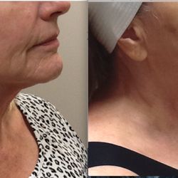 Reflections Body Solutions - Virtue RF-Face & Neck, after 2nd treatment, before the 3rd. Series of 3 txts, then 1 a year to maintain.
