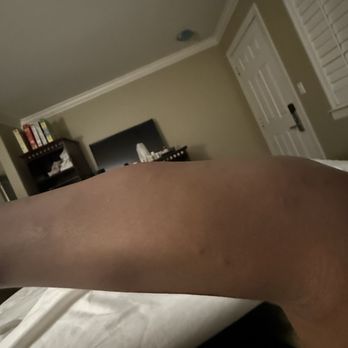 North Bay Inn - BED BUG BITES - Hotels Near Me - San Rafael, California North Bay Inn - BED BUG BITES - Hotels Near Me - San Rafael, California