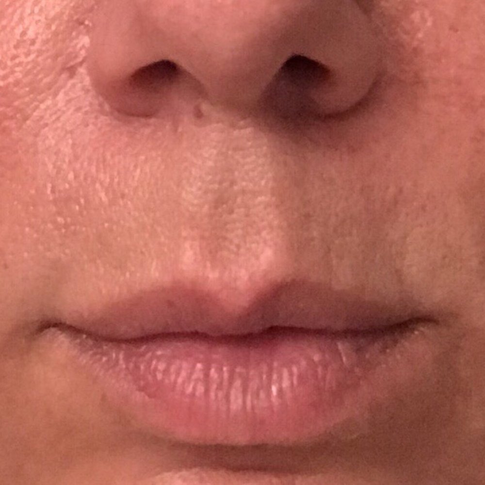 Lazer Lounge - 1 week post procedure - Laser Hair Removal Near Me - Studio City, California Lazer Lounge - 1 week post procedure - Laser Hair Removal Near Me - Studio City, California