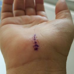 John A Miyano, MD - 8 days post carpal tunnel surgery