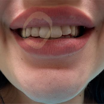 Chino Aesthetic Dental - After my veneer. Super natural results and I'm so happy with the overall look. - Cosmetic Dentists Near Me - Chino, California Chino Aesthetic Dental - After my veneer. Super natural results and I'm so happy with the overall look. - Cosmetic Dentists Near Me - Chino, California